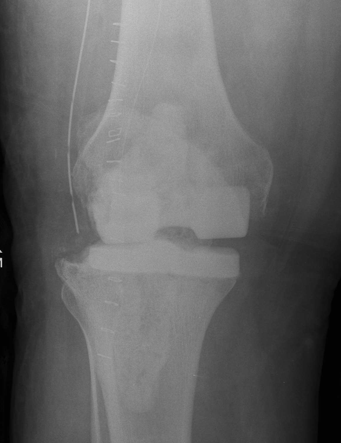 Infected TKR Cement Femur and Tibia AP